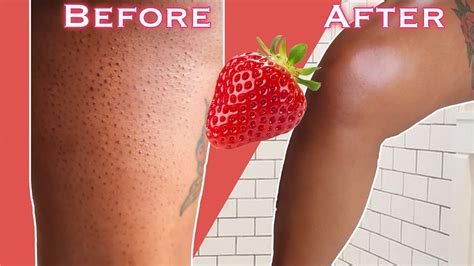 To know how to fix strawberry legs is better if people do the treatment. HOW TO GET RID OF STRAWBERRY LEGS IN ONE DAY! - YouTube