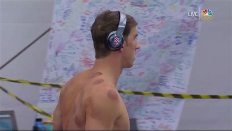 Before the 2004 olympics started, rumor had it. Michael Phelps hat vom Schröpfen rote Kreise auf seinem ...