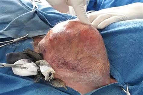 There can certainly be more than one nodule or mass per gland. epashupalan: Livestock News, Livestock information, Animal ...