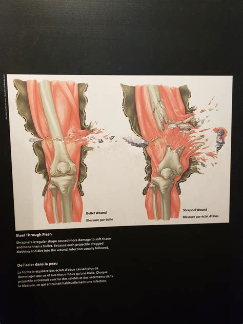 The patient fixed his wounds with duct tape and. Difference between a bullet wound and a shrapnel wound ...