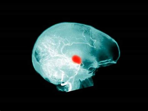 Un aneurisma cerebral ocurre cuando se dilata un vaso sanguíneo y promueve una serie de trastornos que afectan el buen aneurisma cerebral: Aneurisma Cerebral: Aneurisma Cerebral Operacion Secuelas