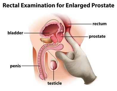 This is called a second cancer. Benign Prostatic Hyperplasia