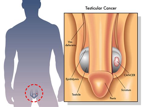 A biopsy will tell if it's cancer or not. Testicular Cancer - Net Health Book