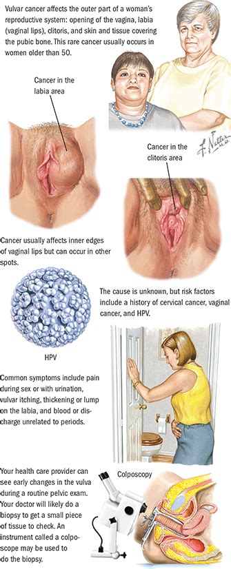 Signs and symptoms of cervical cancer. Papillomavirus test after hysterectomy - Can hpv cause ...