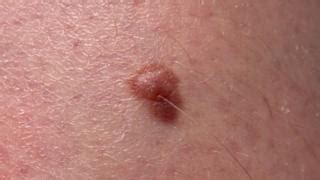 Carcinoma vs melanoma carcinoma is the medical term for serious invasive cancer of epithelial origin. Melanoma blood test: Scientists unveil 'world-first ...