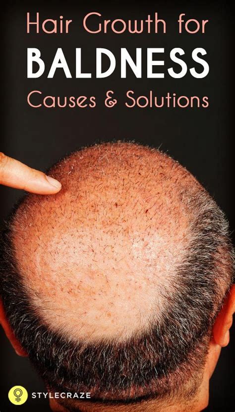 The link between lupus and hair loss Influential applied regrowth hair loss black women link in ...