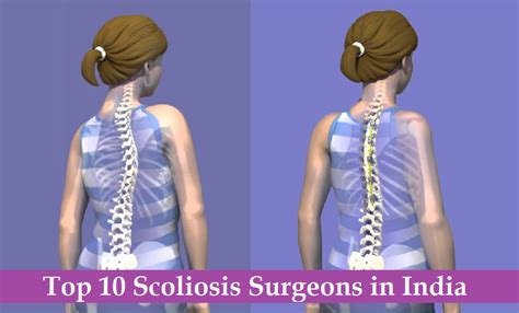 However, the other main types of scoliosis include functional, neuromuscular and degenerative. TOP 10 Scoliosis Surgeons in India - BEST Scoliosis ...