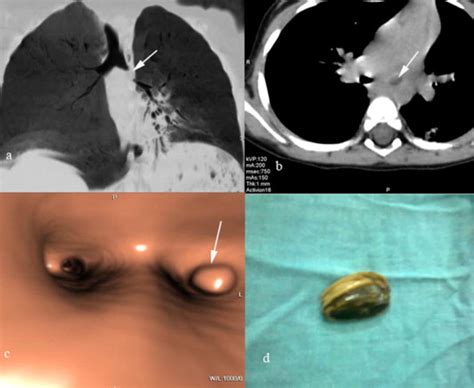 لا اله إلا أنت سبحانگ إني گنت من الظآلمين. Coronal minIP (a), axial (b) and virtual bronchoscopy (c ...