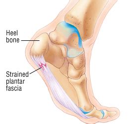 It's a good idea to carry on with these exercises even after the pain goes away, as this can reduce. Plantar Fasciitis - Harvard Health