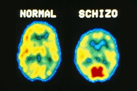 2 видео 1 просмотр обновлен 29 окт. Ostdeutsche leiden stärker unter Schizophrenie -- Das Kind ...