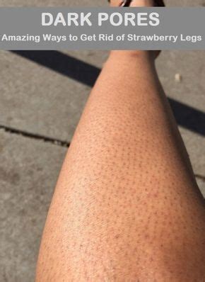Unfortunately, shaving often leads to those dreaded strawberry legs, which are caused by luckily, there are a number of good practices you can incorporate into your cleansing routine so that strawberry legs never return. How to Get Rid of Strawberry Legs | Strawberry legs, Dark ...