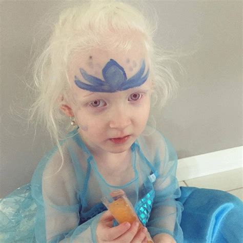 Doctors, parents, and the girls' relatives simply could not believe it. Elsa gives confidence to Queensland girl with Albinism ...