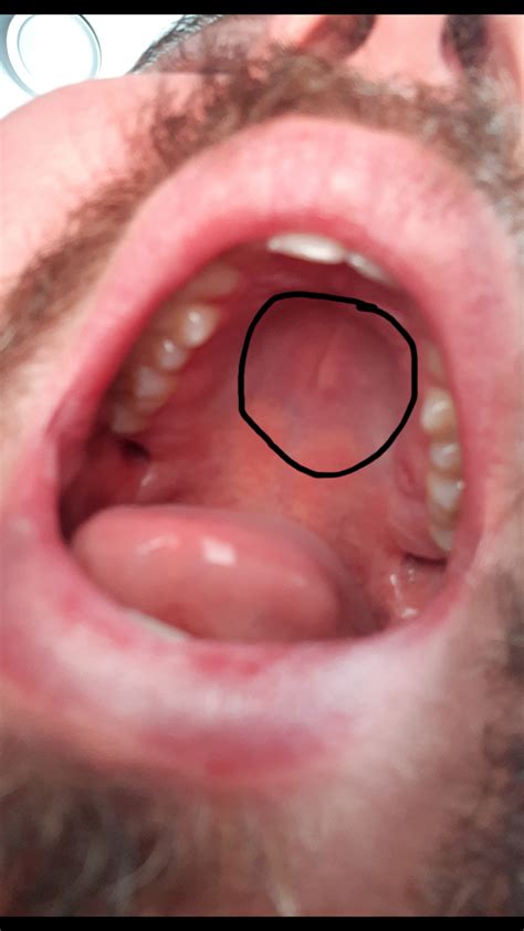 It may be due to the bleeding disorders or excess pressure found on the blood capillaries. Tiny Bumps On Mouth Roof - Bump On Roof Of Mouth Is It A ...