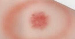 A certain kind of rash, called erythema migrans, is a telltale symptom of lyme disease, and if you have it call your doctor immediately. Zapper_Dave: Lyme Disease - Hitting the Bull's Eye