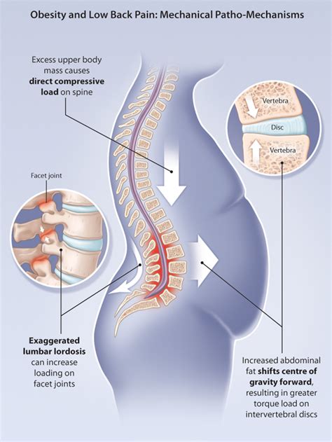 The lower back consists of the lumbar spine (bony structures called vertebrae surrounding the nerves of the spinal cord). How Losing Weight Can Help Reduce Back Pain | Excel ...