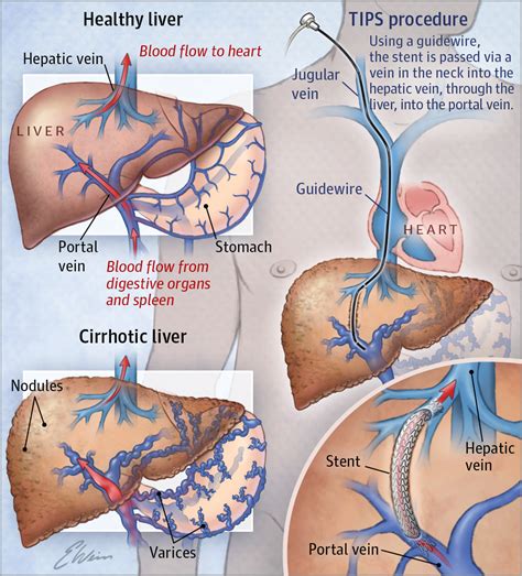 Free learning resources for students covering all major areas of biology. Transjugular Intrahepatic Portosystemic Shunts. | Patient ...