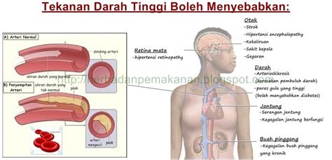 Kondisi ini umumnya tidak menimbulkan gejala hipertensi, karena itu banyak yang tidak mengetahui bahwa dirinya memiliki riwayat penyakit ini. Tekanan darah tinggi: Bolehkah diet menggantikan ubat ...