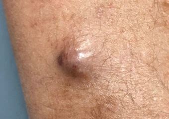 Merkel cell carcinoma (mcc) is a rare, aggressive form of skin cancer with a high risk for returning merkel cell carcinoma (mcc) is 40 times more rare than melanoma, with an estimated one case per. Wife, Advocate, Motivator: When Someone You Love Is ...