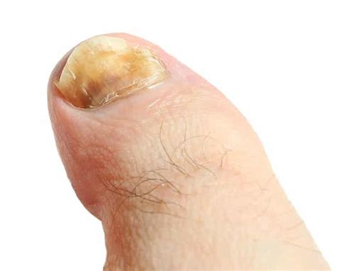 Quels sont les symptômes de la mycose des ongles des pieds