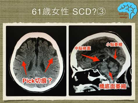 脊髄小脳変性症(SCD)の女性、濃厚な家族歴あり？ - 鹿児島認知症 ...