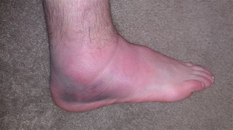 We did not find results for: Gambar Luka Jatuh Dari Motor Di Kaki Sama Tangan - Gambar ...
