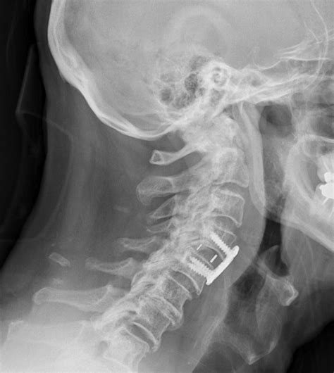 Patologia vertebrale mininvasiva - Neurochirurgia Ferrara ...