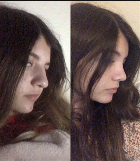 Filmi after we fell'in ne zaman. Before and after rhinoplasty (3 months post op) 💕💕 ...