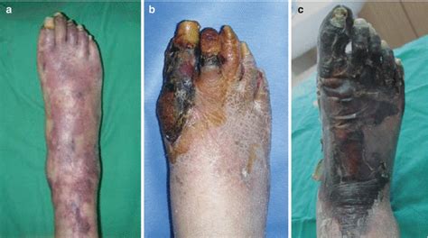 In a simplified clinical classification approach, diabetic foot ulcers can be characterized as neuropathic, ischemic, or neuroischemic, depending on how complications such as peripheral neuropathy and arterial disease affect the ulcer's etiology. Diabetic Foot: Ulcer, Infection, Ischemic Gangrene ...