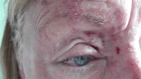 Herpes infections are caused by herpes simplex viruses, which enter through the skin and travel to the nerves, where they generally do not. Facial Shingles (Herpes Zoster) before and 4 days after ...