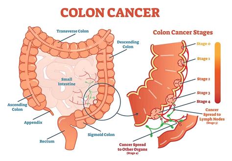 It is also the second leading cause of cancer. 10 Warning Signs of Colon Cancer; Colon Cancer Symptoms ...