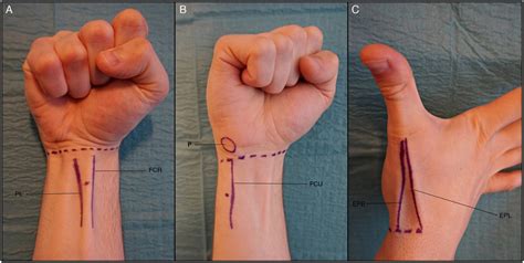 Learn about carpal tunnel syndrome, a common condition where the median nerve in the wrist is compressed, causing pain and numbness throughout your hand. Peripheral nerve blocks at the wrist. A, Median nerve ...