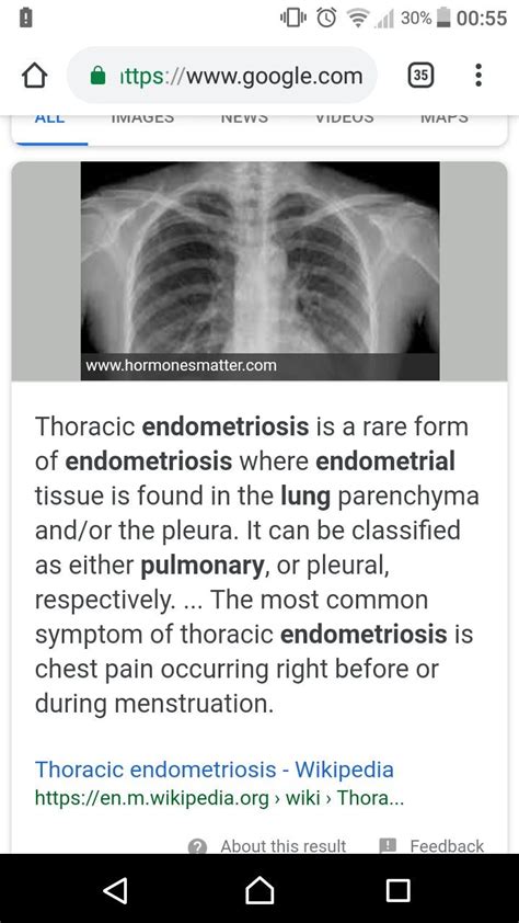 Endometriosis is a full body condition in which cells similar to those in the endometrium, the layer of tissue that normally covers the inside of the uterus, grow outside the uterus. Pin by Witchie Witch on My illnesses | Endometriosis ...