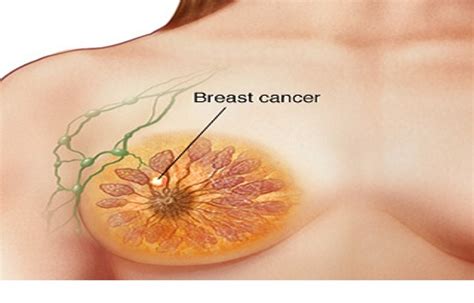 Most breast cancer symptoms are discovered by women during regular daily activities like bathing. Scientists Discovered: These 2 Ingredients Cure Even ...