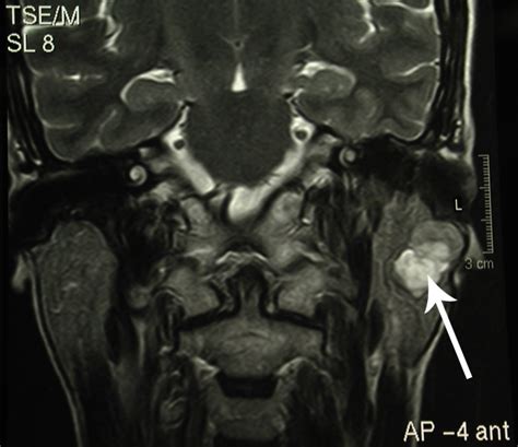 A case is presented of a young female with parotid recurrent pleomorphic adenoma and skin gli autori descrivono il caso di una giovane donna affetta da adenoma pleomorfo parotideo ricorrente ed. Chirurgia della parotide