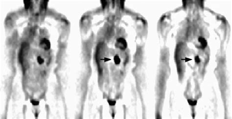 A ct scan (also called a cat scan or computed tomography scan) can help doctors find cancer and show things like a tumor's shape and size. Colorectal Cancer - SNMMI