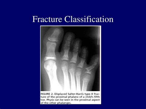 PPT - Foot Stress Fractures PowerPoint Presentation, free ...
