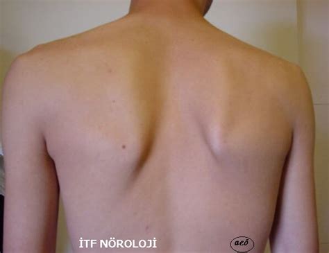 Kürek kemiği ağrısı ya da kürek kemikleri civarında ağrı hemen herkesin zaman zaman tecrübe ettiği bir sorundur. Scapular Kanatlaşma | BodyForumTR Vücut Geliştirme Forumu