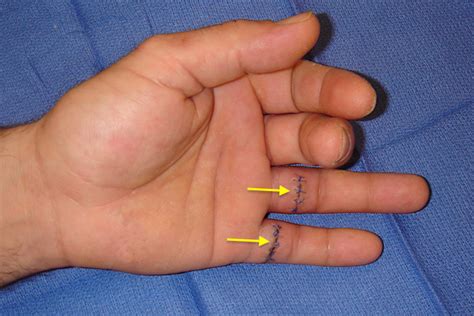 Angular joint displacement as a function of a controlled tendon excursion driven by computerized motors was used to quantify the kinematics of the finger. FLEXOR TENDON LACERATION | Hand Surgery Source