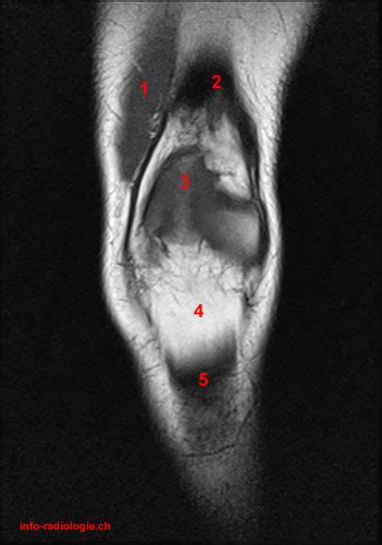 An understanding of normal anatomy and biomechanics of the knee extensor mechanism is necessary to comprehend the imaging of extensor mechanism injuries. Atlas of Knee MRI Anatomy - W-Radiology