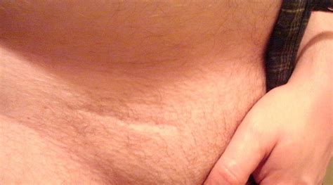 Other symptoms of testicular cancer usually do not appear until after the cancer has spread to other parts of the body. Testicular cancer