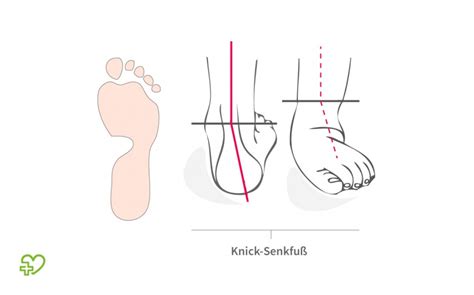 Bitte achten sie auf die richtige socke für rechts und links. Kindlicher Knick-Senkfuß - Onmeda.de