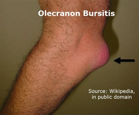 A greek compound of ὠλένη (ōlénē, elbow) and κρανίον (kraníon, head). Elbow Pain Causes and Treatment | Bone and Spine