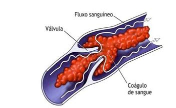 A trombose venosa profunda (tvp) é uma condição clínica caracterizada pela formação de um trombo (coágulo) no lúmen de uma veia do sistema venoso profundo, ou seja, as veias situadas. SAÚDE,CORPO E BELEZA: Lipoaspiração x Trombose Venosa Profunda