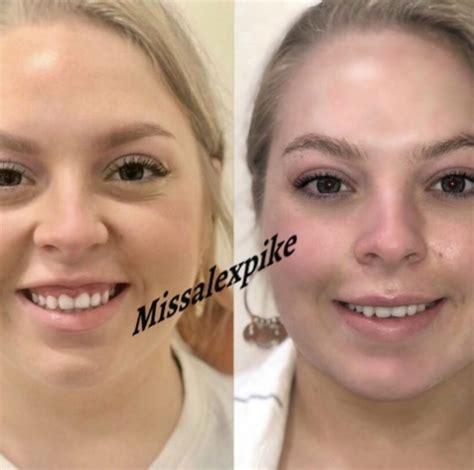 Alex pike registered nurse, director at face clinic and delete medical laser albury and working in melbourne. Gummy Smile - Face by Alex Pike