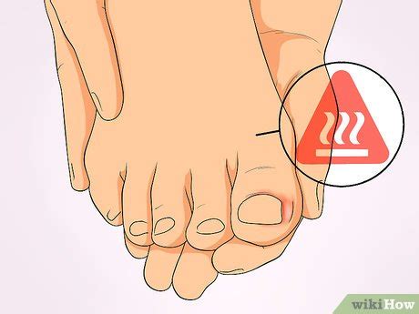 Ingrown toenails are a common condition in which the corner or side of a toenail grows into the soft flesh. 3 Ways to Tell if an Ingrown Toenail Is Infected - wikiHow