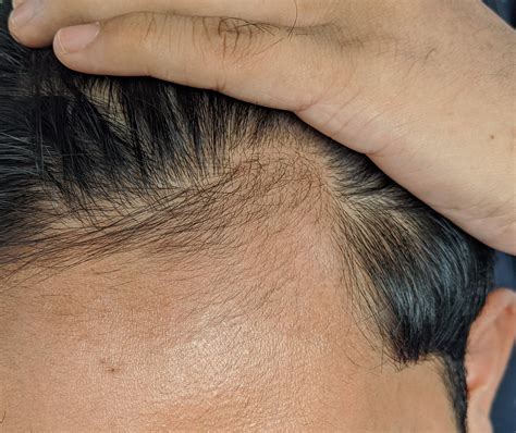 How to stop a hair loss? 2 months of minoxidil, spotted some baby hair growing on ...