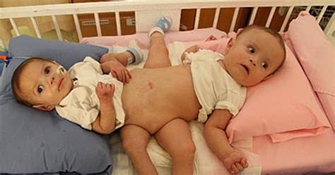 Translations of the phrase siamesische zwillinge from german to english and examples of the use of siamesische zwillinge in a sentence translation of siamesische zwillinge in english. Conjoined baby boys separated after nine-hour operation ...