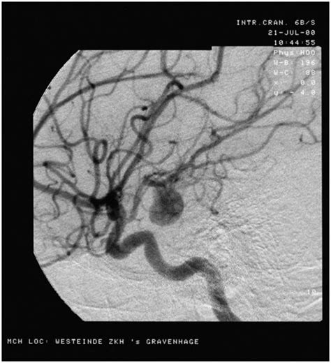 What is a cerebral aneurysm? Detectar el aneurisma cerebral | Consumer