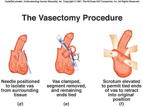 Reversal surgery is more complicated than vasectomy, can be expensive and is ineffective in some cases. 1000+ images about Men's Health on Pinterest | Sunglasses, Natural foods and Live happy
