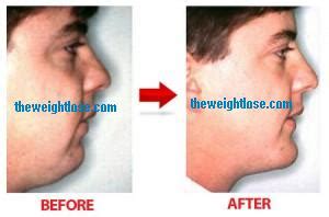 Yes, it will take you some time to lose overall weight and to lose the fat from the face. Lose Fat: How To Lose Face Fat?